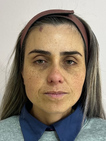 Nuze antes da harmonização facial